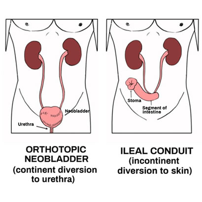 Cosa succede dopo la cistectomia per tumore vescicale? 