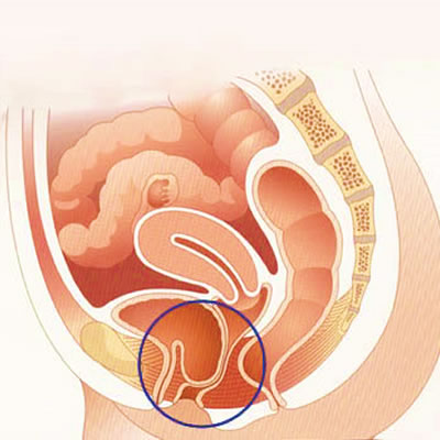 Il prolasso pelvico della donna: un problema frequente ma molto spesso trascurato per lungo tempo