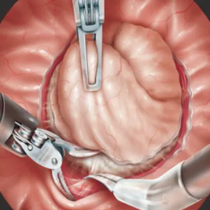 Prostata Ingrossata: Chirurgia Robotica (Rasp) ed Enucleazione a confronto in un nuovo studio internazionale