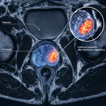 Risonanza magnetica della prostata positiva: significa avere un tumore?