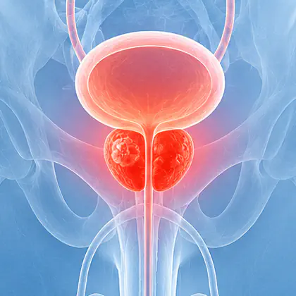 Tumore prostata: i primi sintomi