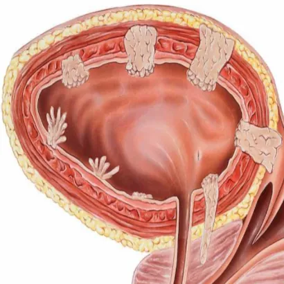 In quanto tempo si sviluppa un tumore della vescica? cosa dicono gli studi scientifici