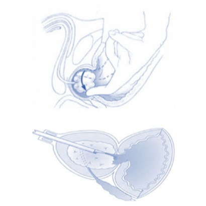 C’è ancora spazio per la TURP e la prostatectomia semplice nel 2025? 